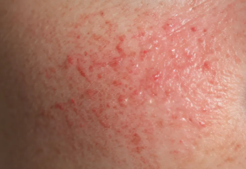 psoriasis causes