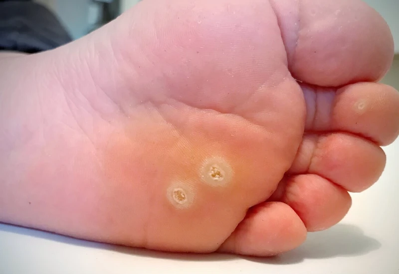 foot wart