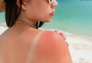 what is sunburn?