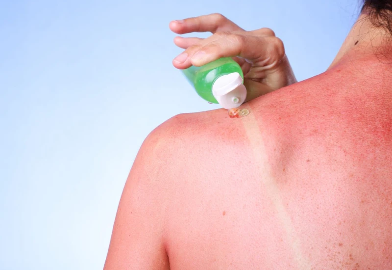 sunburn lotion