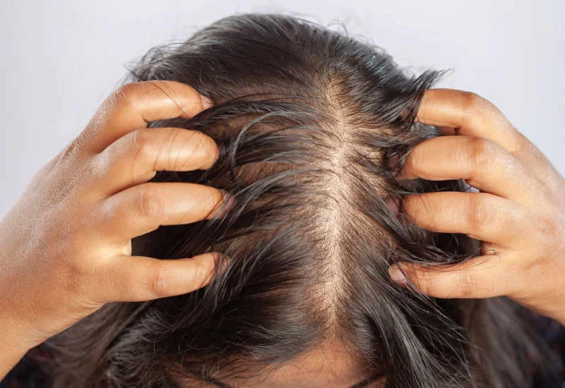 Head Lice Symptoms