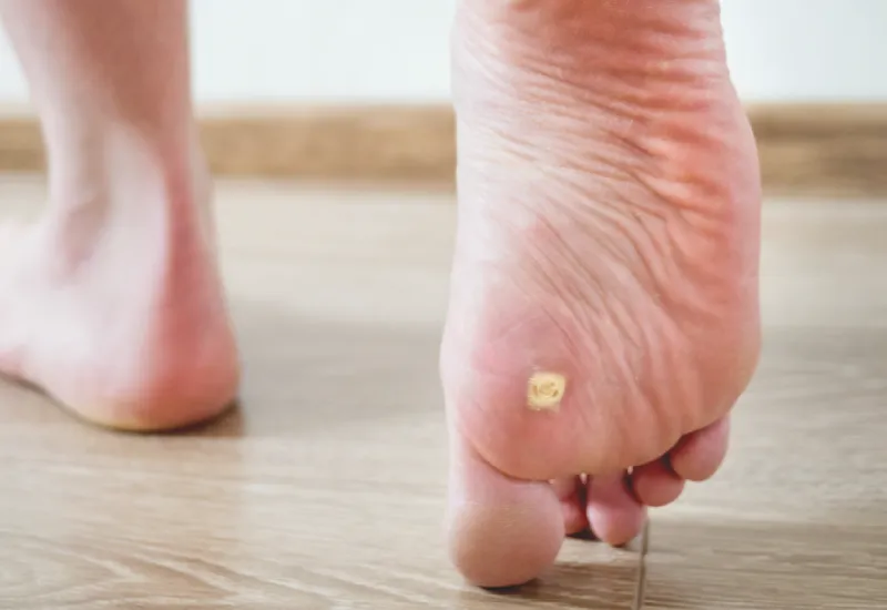 what are foot corns and calluses?