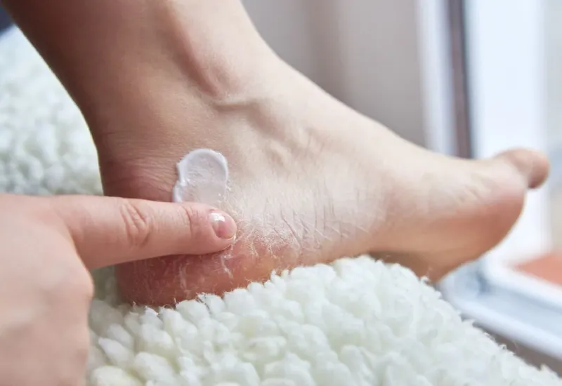 foot cracks treatments