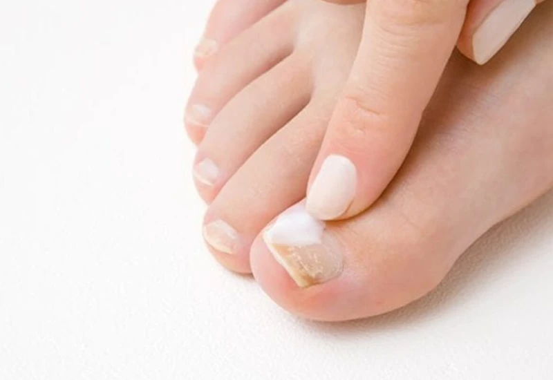 nail fungus causes