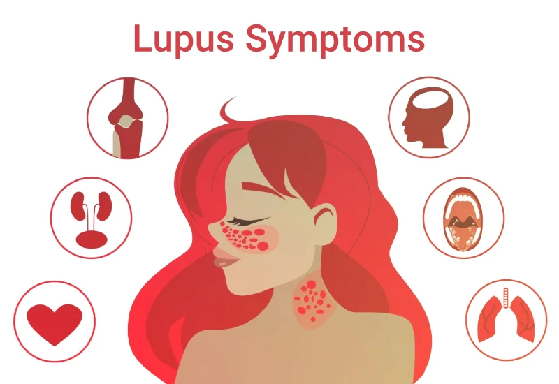 symptom of lupus