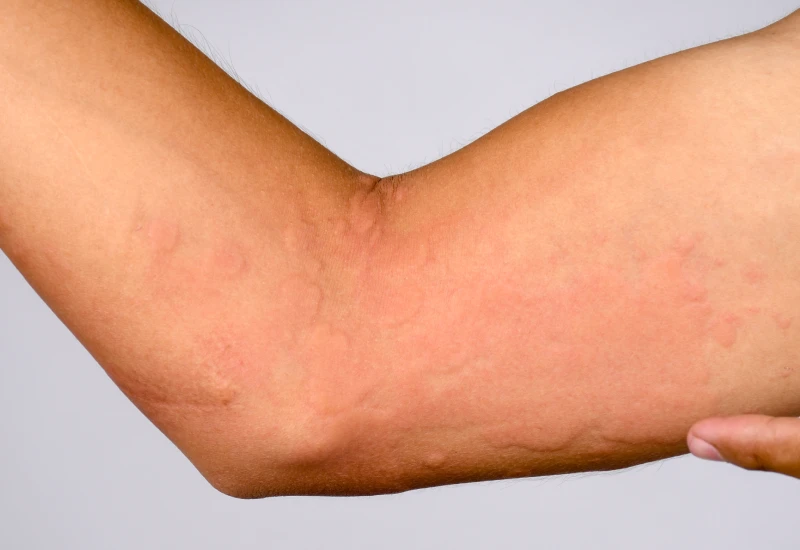 Hives Symptoms