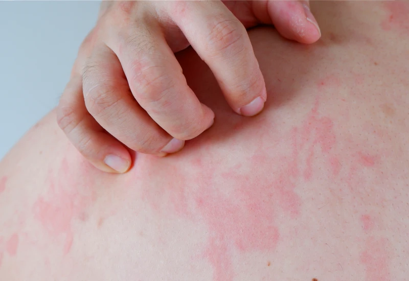 Hives in Adults