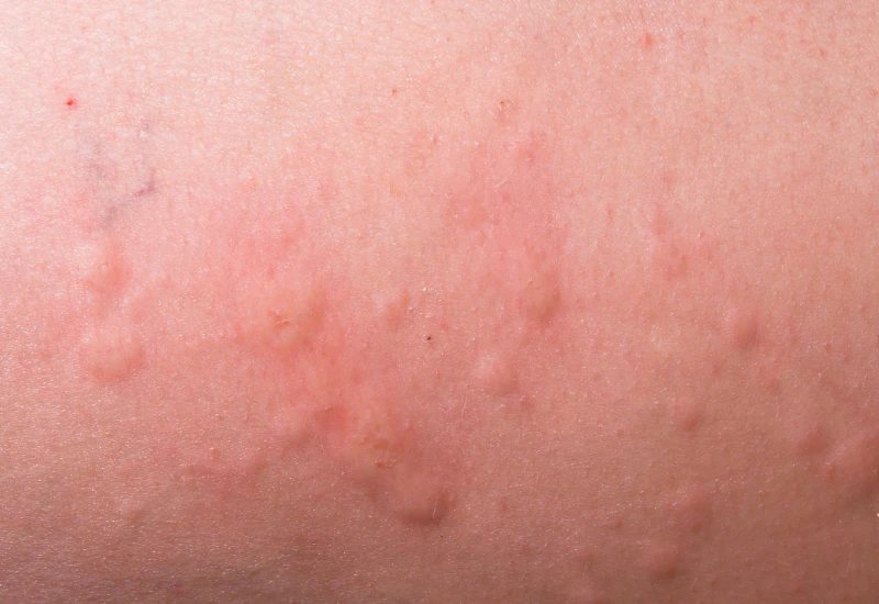 Pictures of Hives