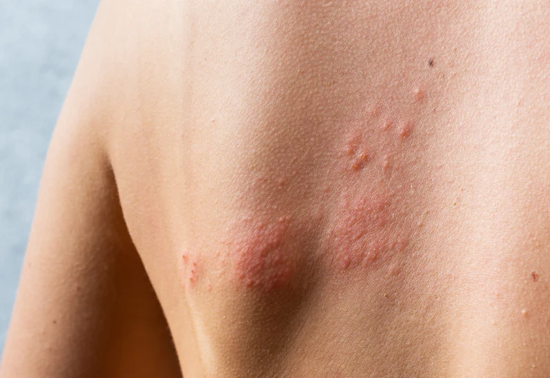 Shingles Causes