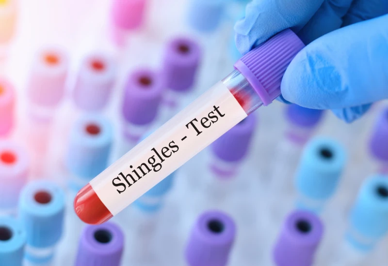 Shingles Test