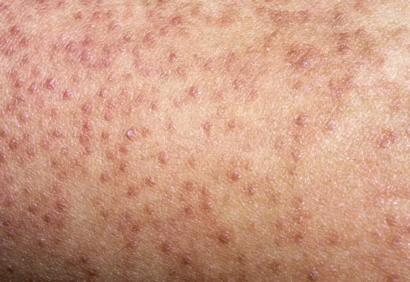 Keratosis Pilaris symptom