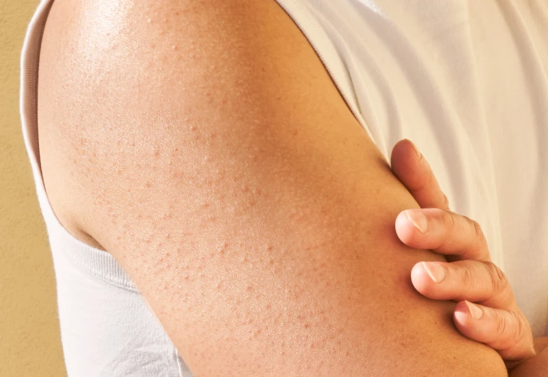 Keratosis Pilaris