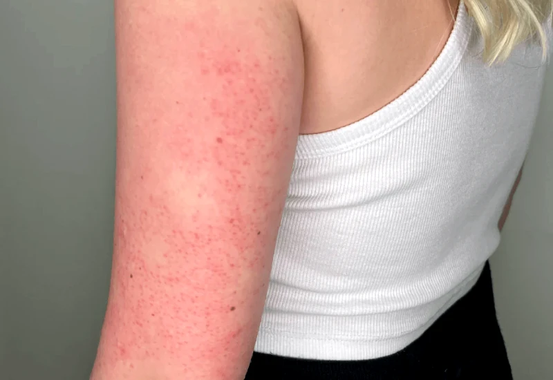 Keratosis Pilaris causes