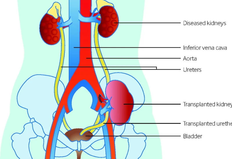 Kidney Transplantation treatment