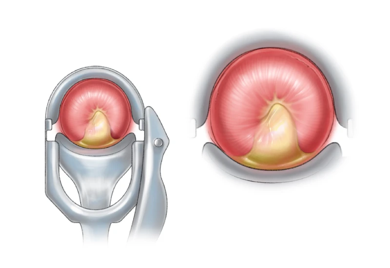 Cervicitis symptom