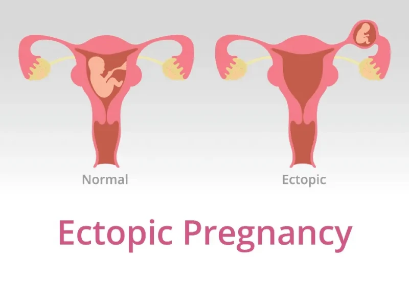 what is ectopic pregnancy