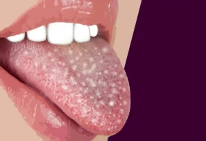 oral lichen planus