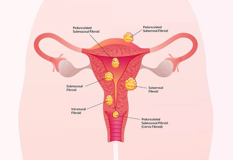 Uterine Fibroid Treatment