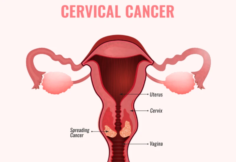 What Is Cervical Cancer?