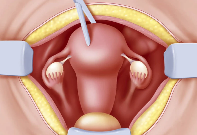 hysterectomy procedure