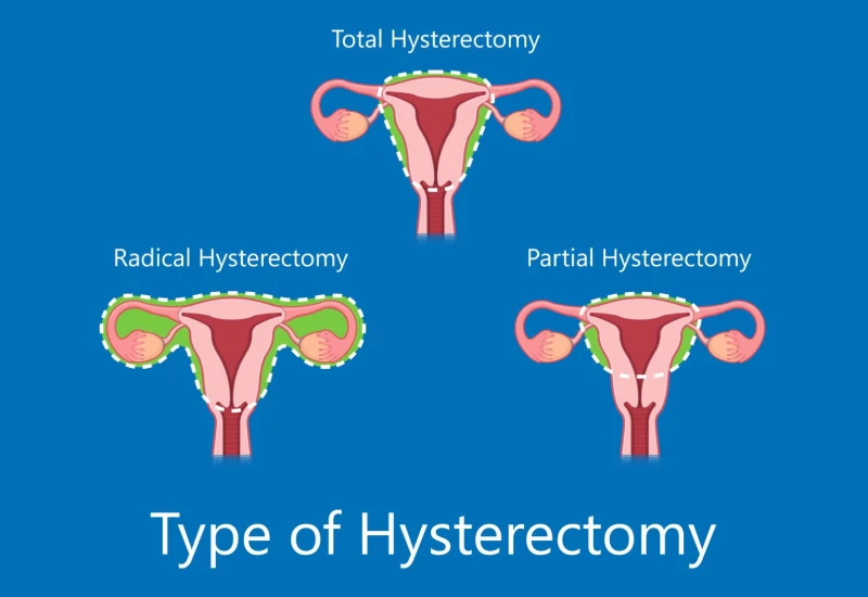 hysterectomy types