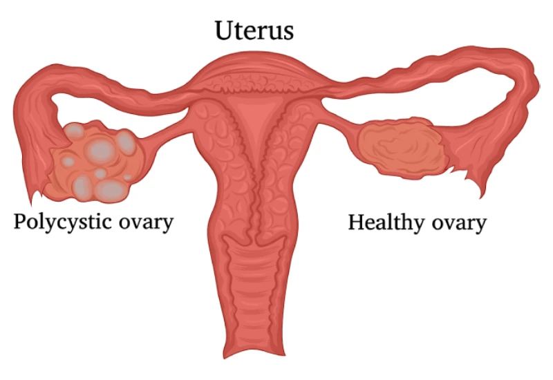 Polycystic Ovary Syndrome Treatment