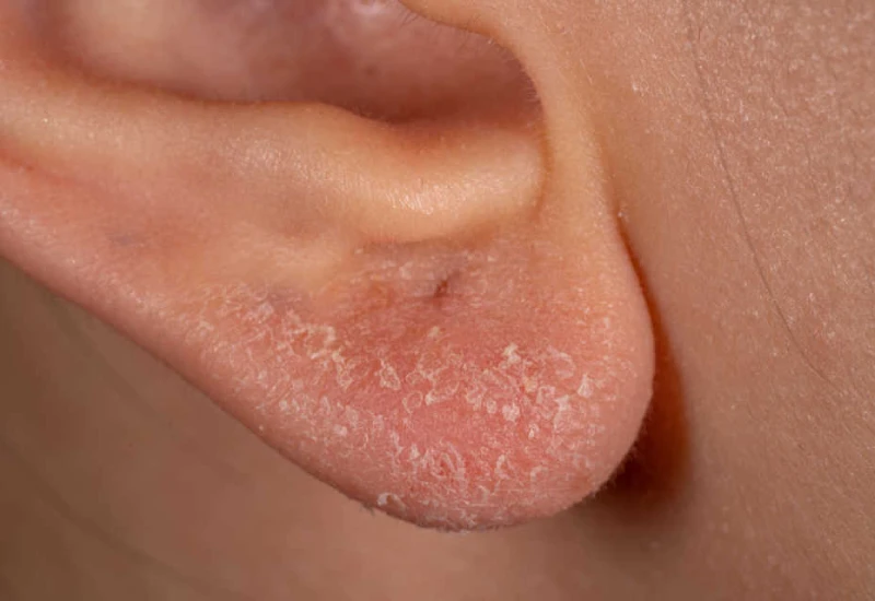 Ear Eczema