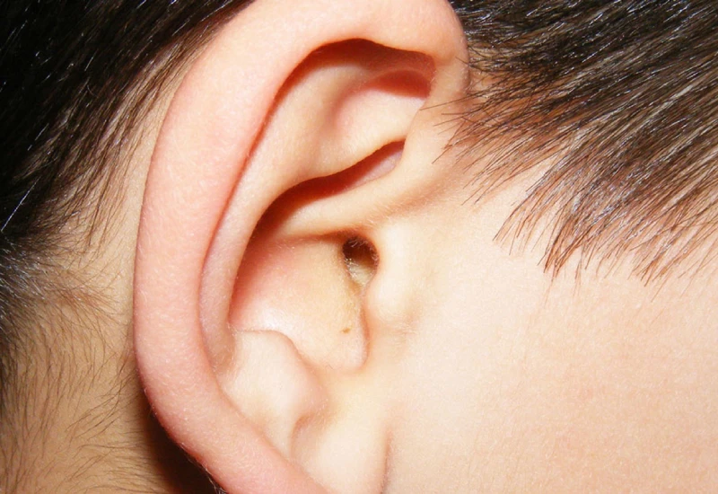 Glue Ear