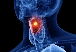 Laryngeal Cancer