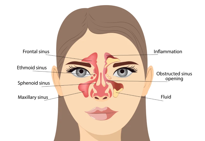 Sinusitis Infection