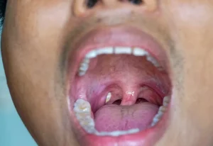 Tonsil Stones