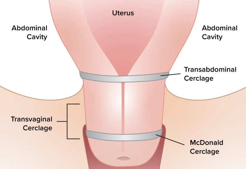 Cervical Cerclage Definition