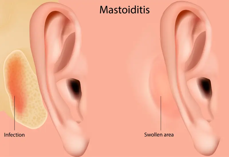Mastoiditis Risk Factor