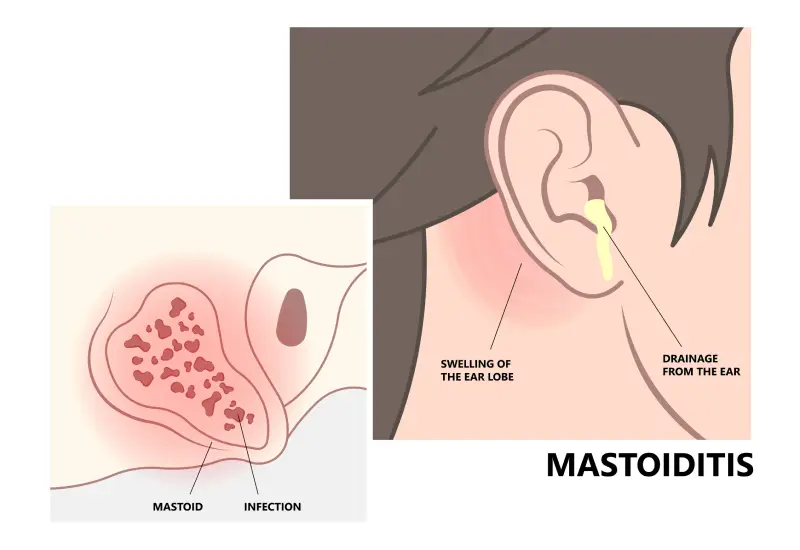 Mastoiditis Symptoms