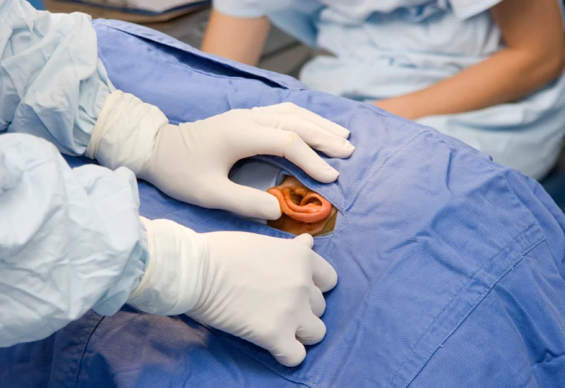 Eustachian Tube Dysfunction Surgery